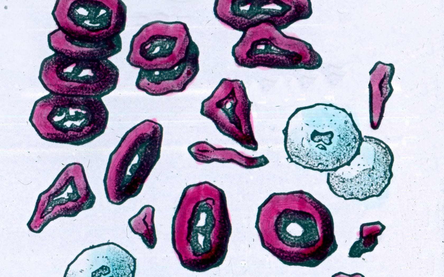 Poster depicting the degeneration of blood cells.